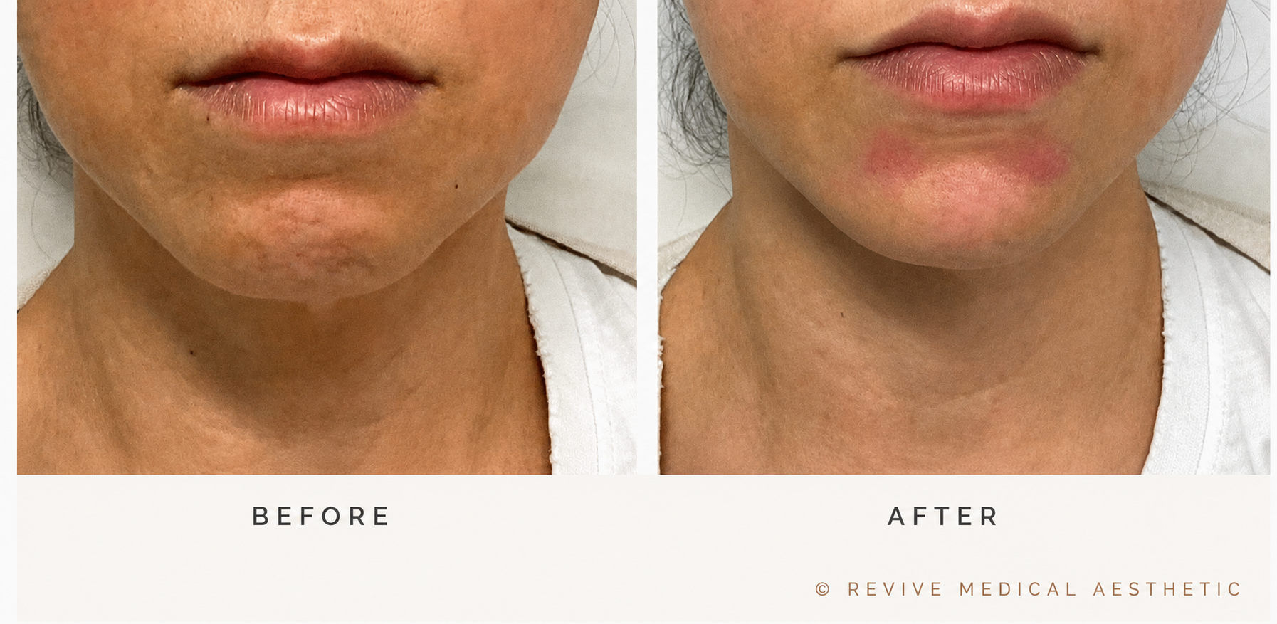 Before-and-after lower-face clinical photographs