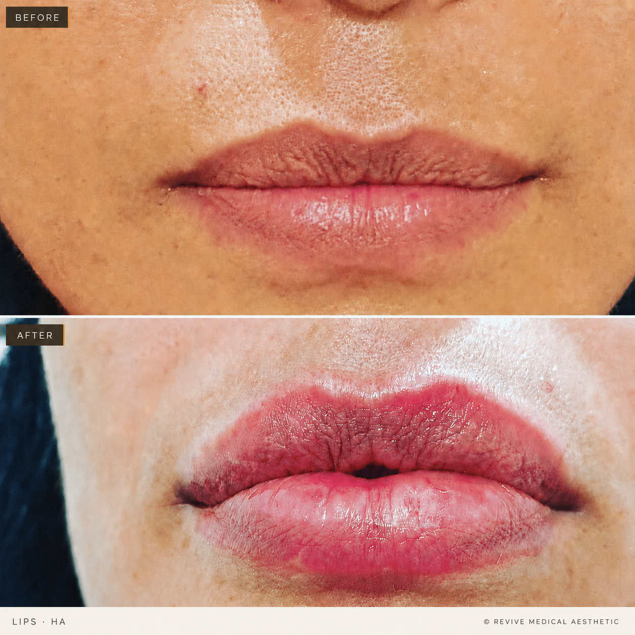 Before-and-after lip clinical photographs