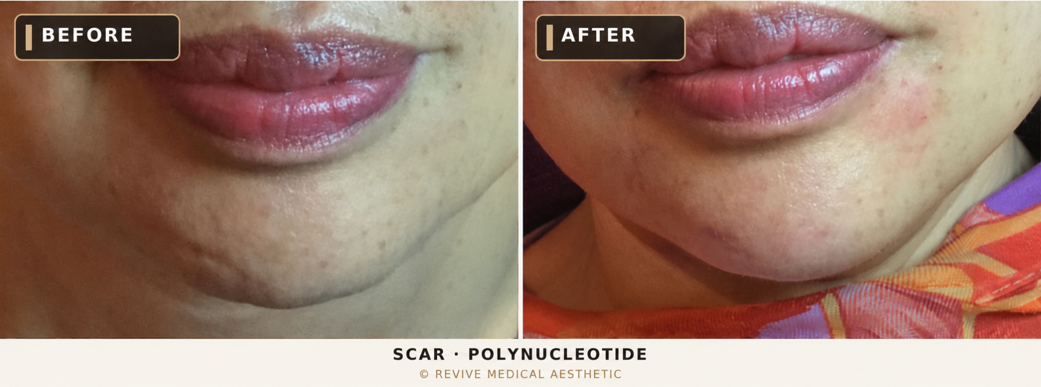 Before-and-after facial scar clinical photographs