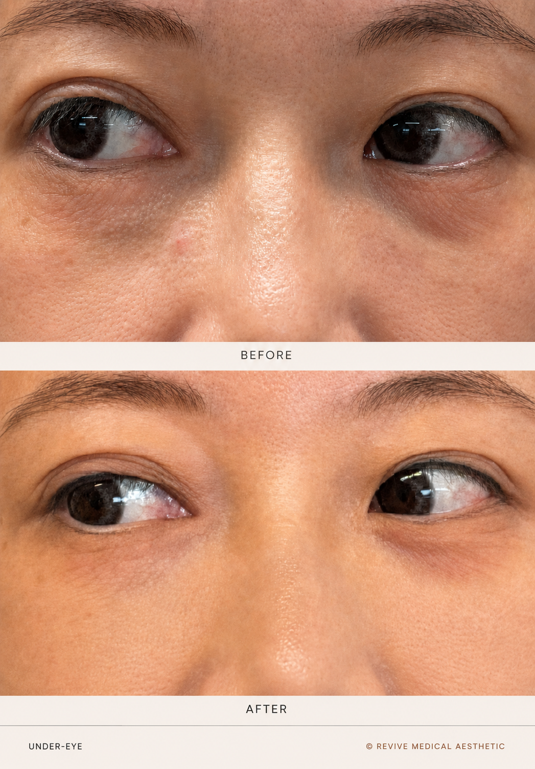 Before-and-after under-eye clinical photographs